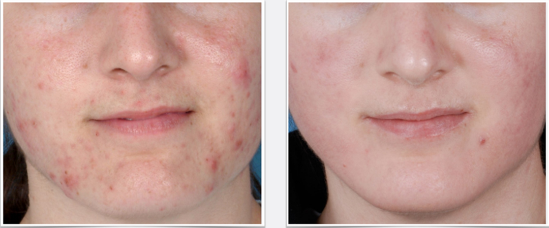 Acne Scar Treatment Tulsa - Kinetic Clinic Medical Wellness Clinic